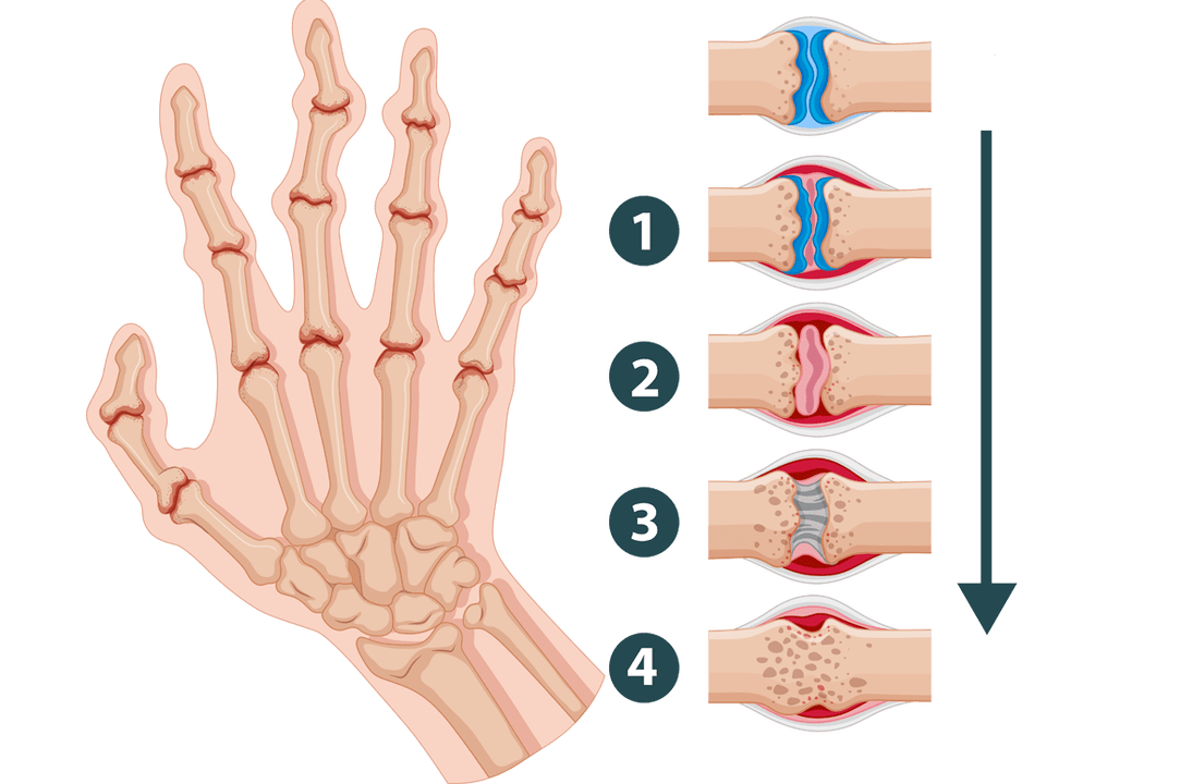 Estágios de desenvolvimento da artrite - danos inflamatórios nas articulações