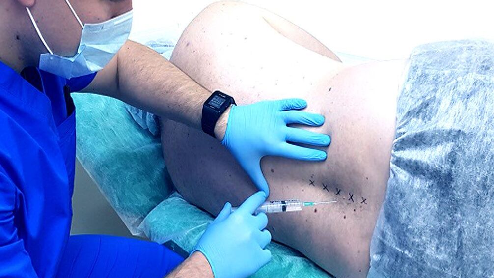 Bloqueio espinhal para osteocondrose