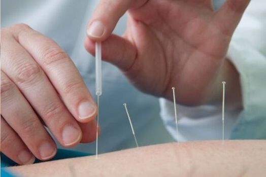 A acupuntura é um método de tratamento da dor na região lombar causada pela osteocondrose