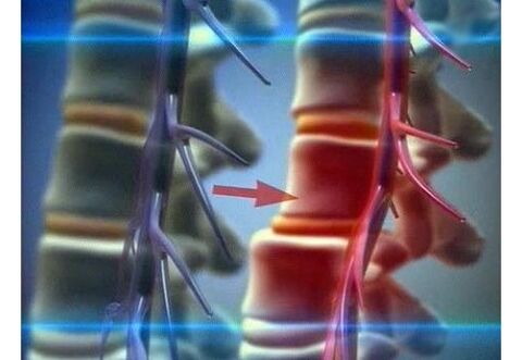 Compressão de terminações nervosas na osteocondrose lombar