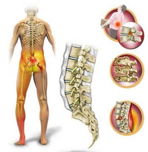 Osteocondrose da coluna lombar, causando dor lombar