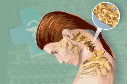 sintomas reflexos da osteocondrose
