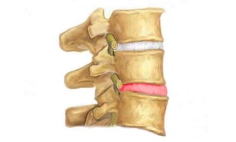 Protrusão do disco intervertebral da coluna vertebral - um sinal de osteocondrose