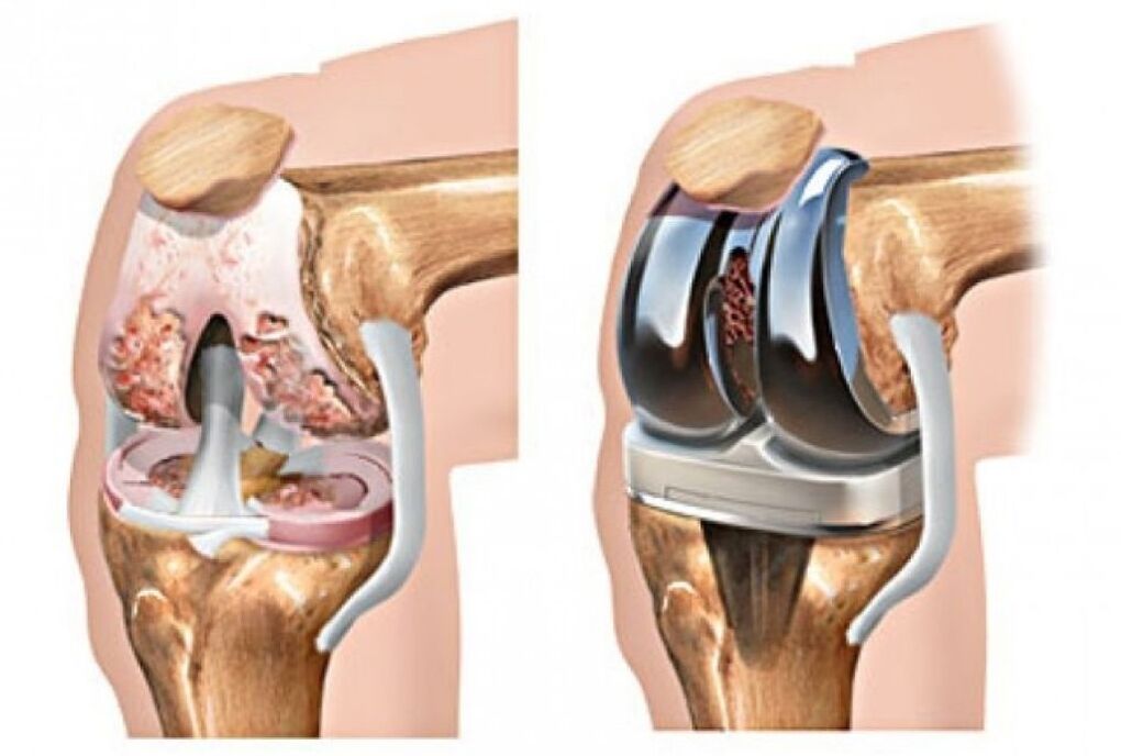 artroplastia de joelho para artrose