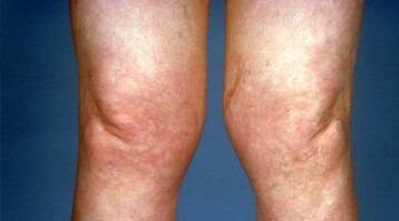 deformidade das articulações do joelho com artrose