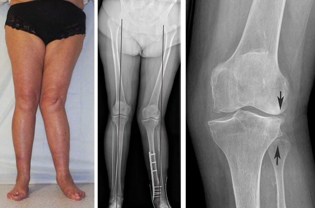 quadro clínico da osteoartrite do joelho
