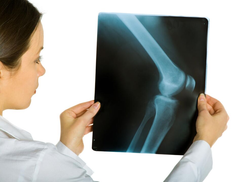 A radiografia da articulação do joelho revelará a presença de artrose deformante