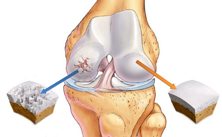 Articulação do joelho saudável (direita) e afetada por artrose (esquerda)