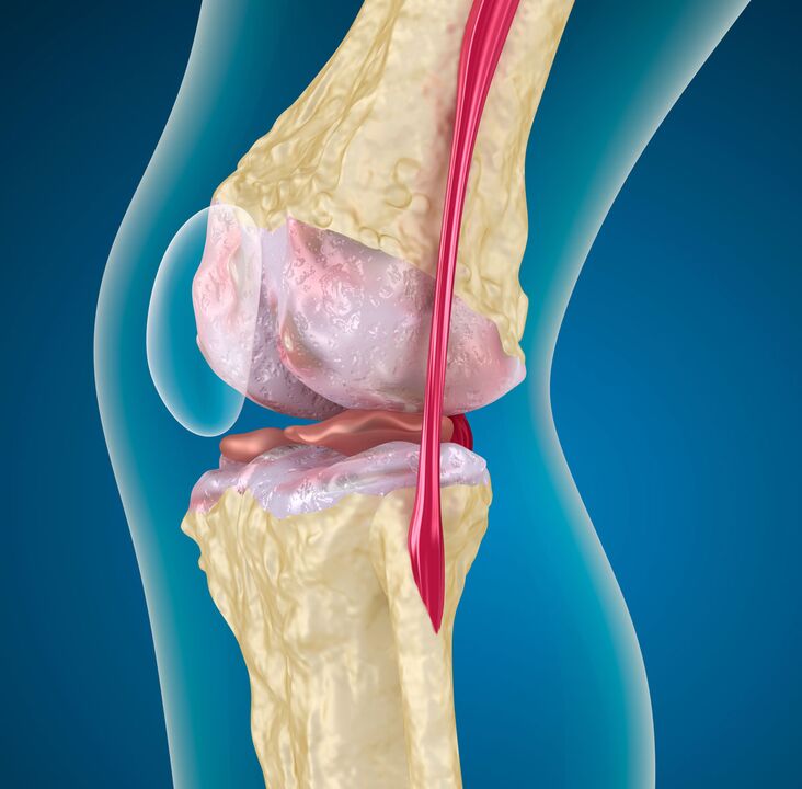 Artrose da articulação do joelho - uma doença degenerativa-distrófica